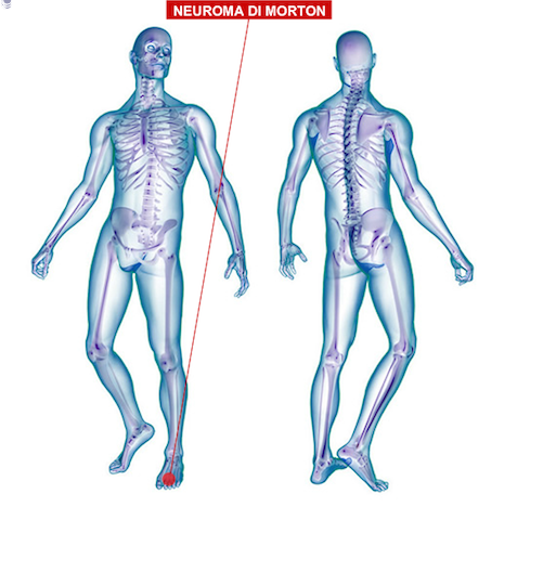OZONOTERAPIA E IL NEUROMA DI MORTON